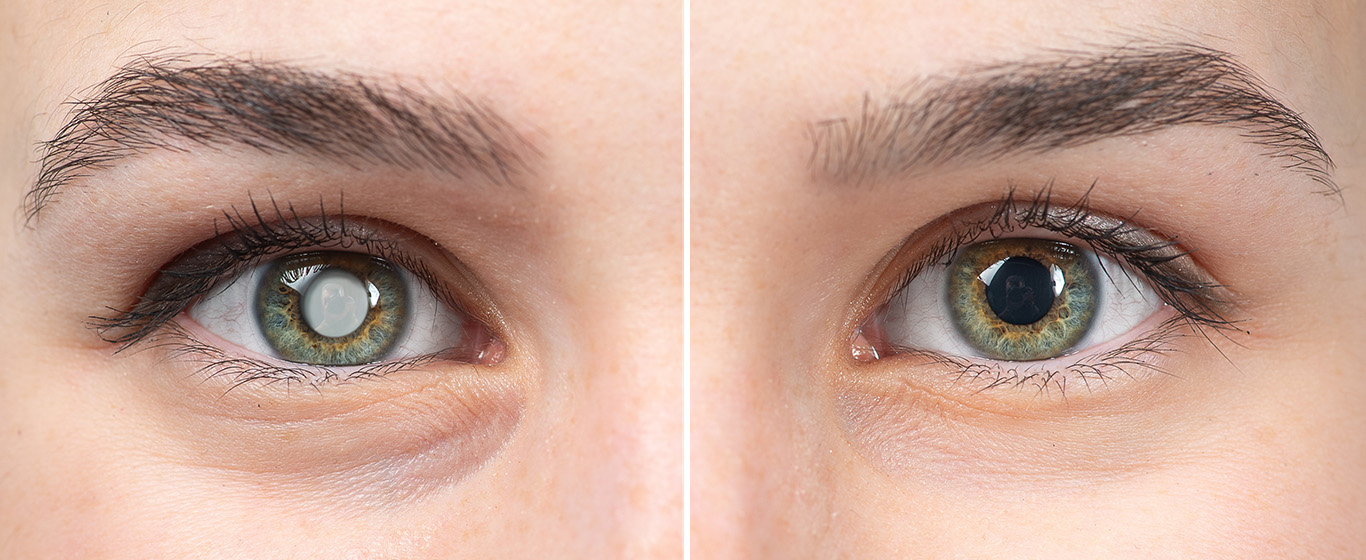 Glaucoma